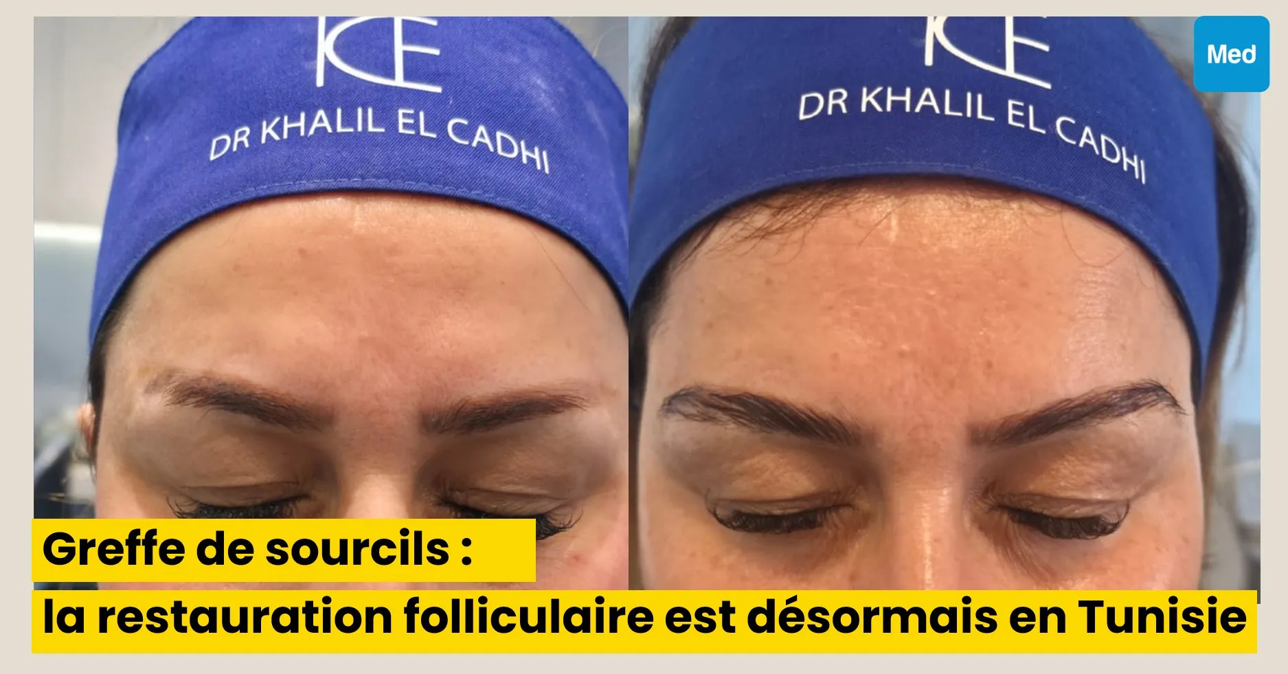 Greffe de sourcils : une microchirurgie de restauration folliculaire, désormais pratiquée en Tunisie